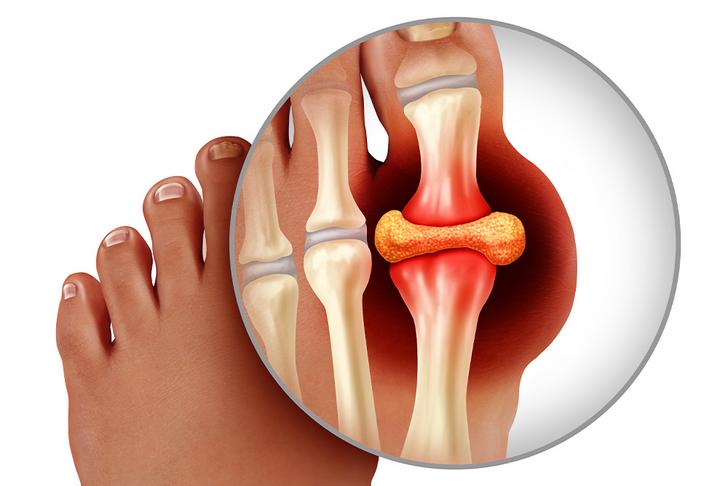 home remedies for gout