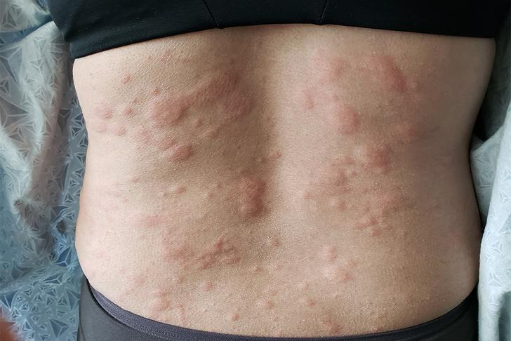 home remedies for hives