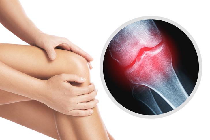 osteoarthritis symptoms