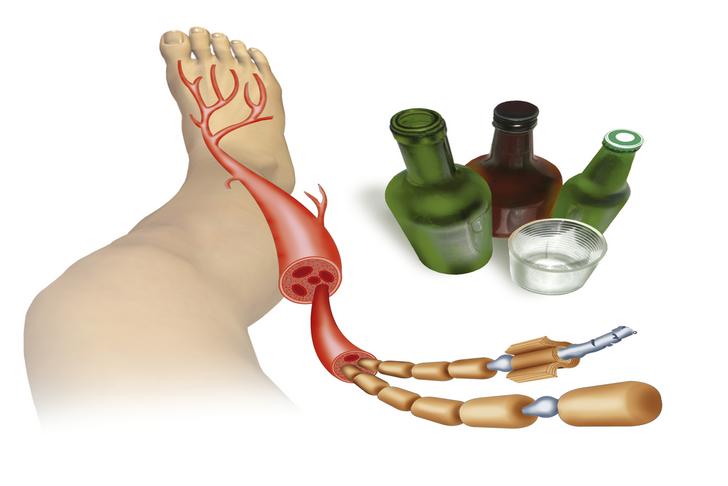 alcohol neuropathy