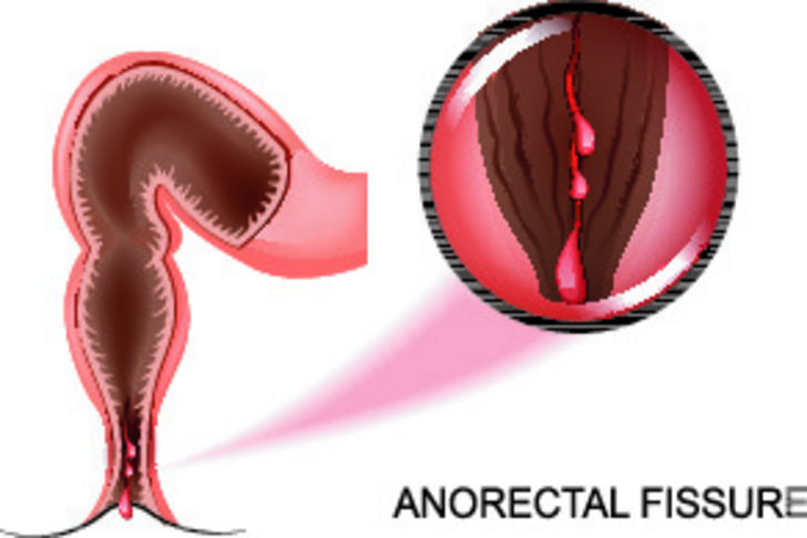 anal fissures-constipation