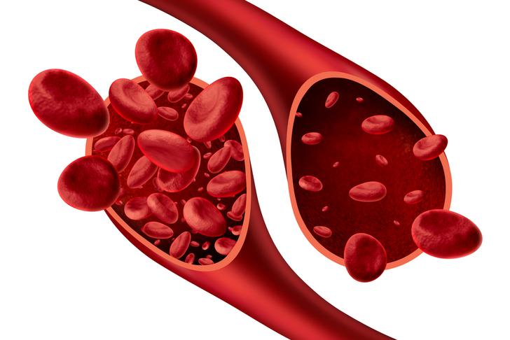 anemia of-chronic-disease