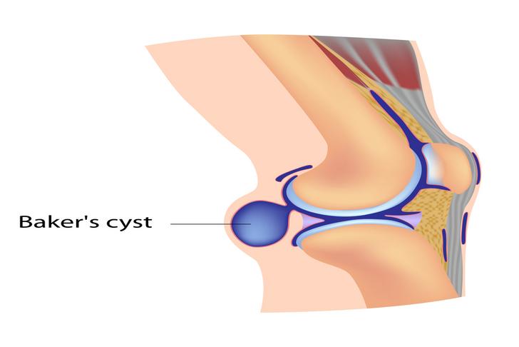 bakers cyst-knee