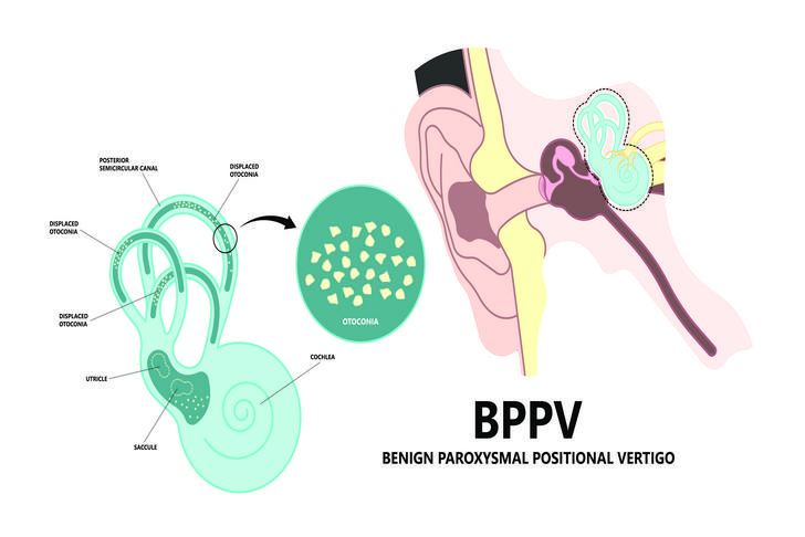 bppv