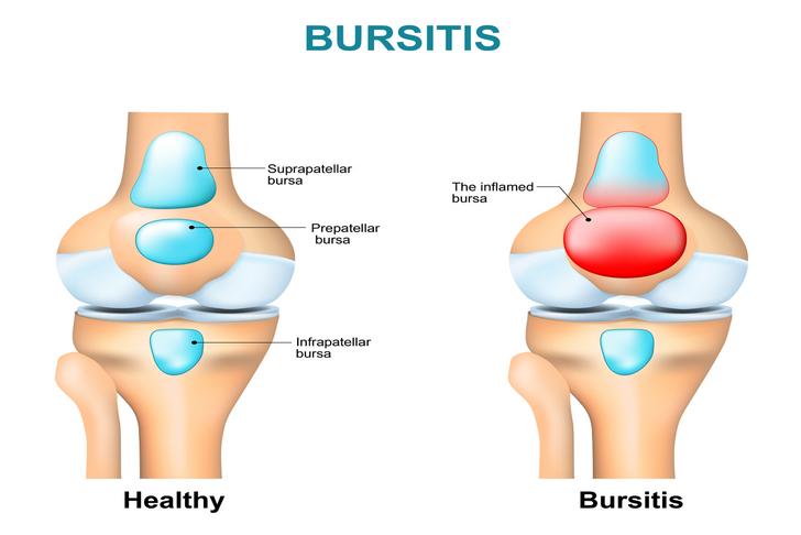 bursitis knee