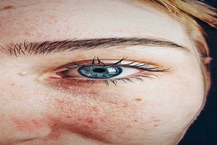 close up of person's face showing red bumps on skin