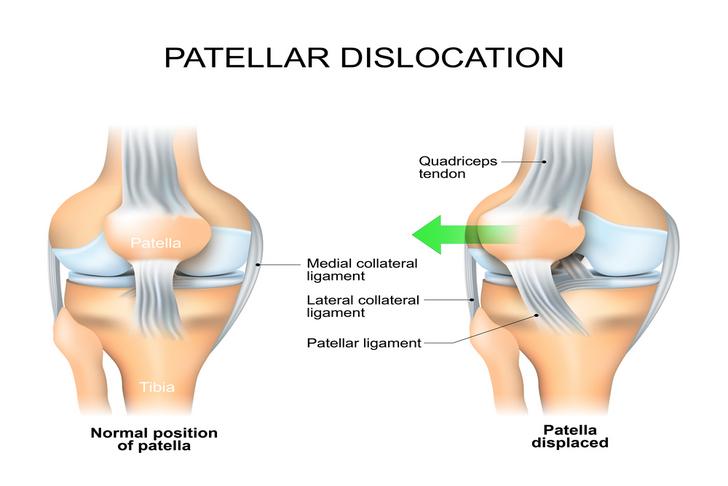 dislocated kneecap