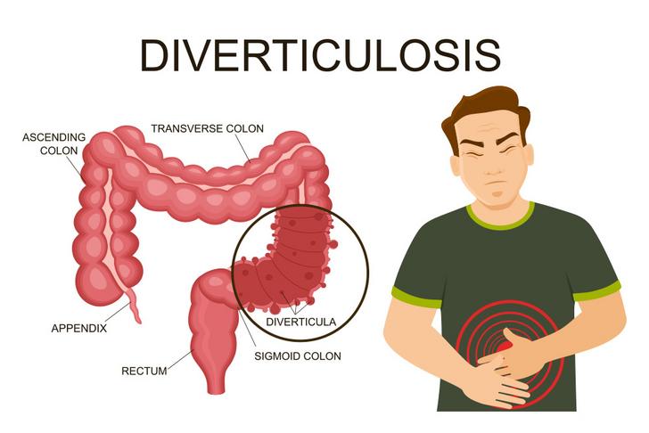 diverticulosis