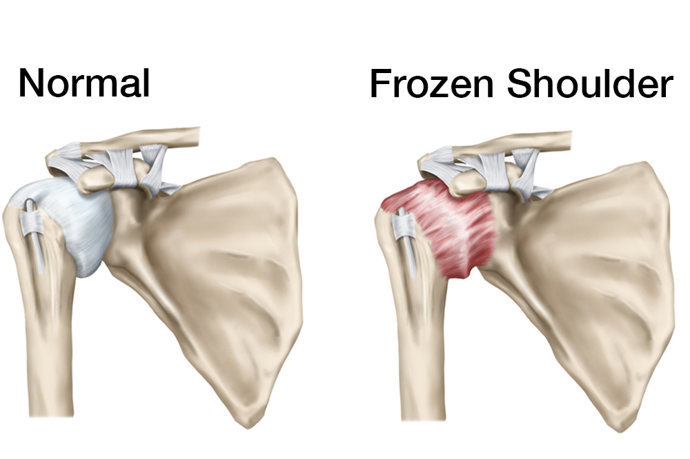frozen shoulder