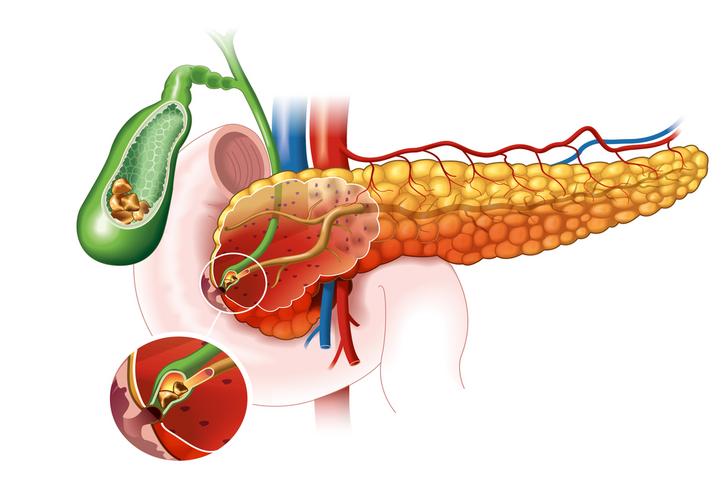 gallstones pancreatitis