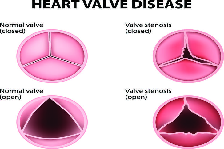 heart valve-problems-low-blood-pressure