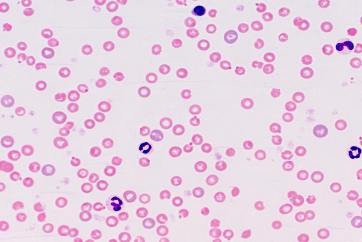 hemolytic anemia