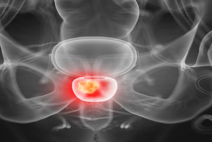 inflammation prostate-cancer