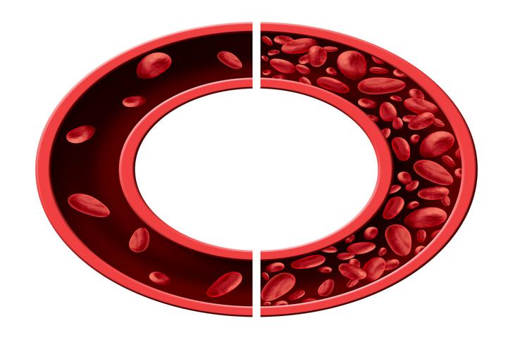 iron deficiency-anemia