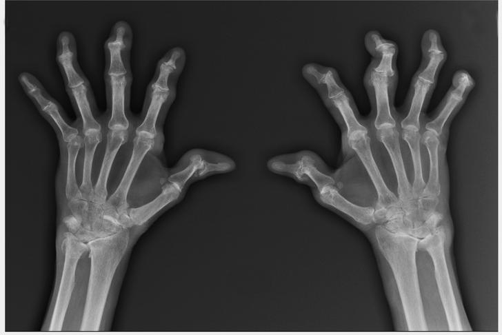 joint deformity-osteoporosis