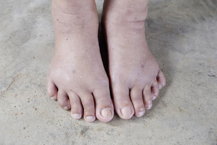 medications swollen-feet