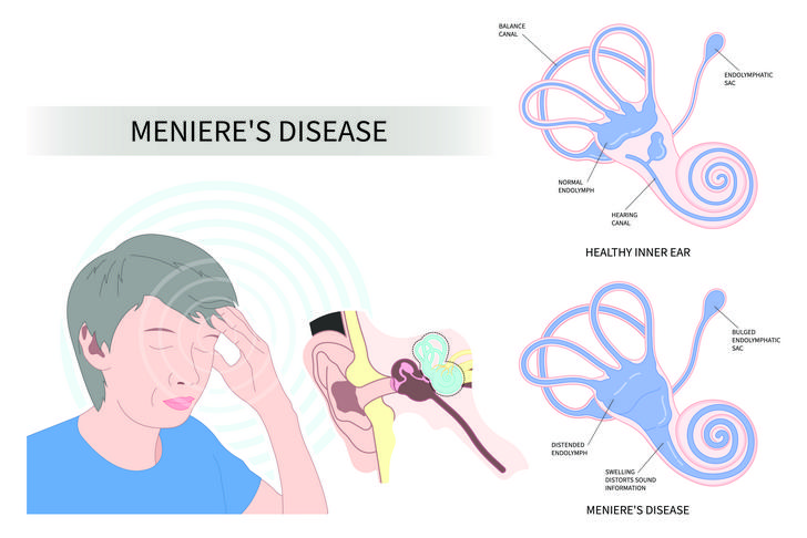 menieres disease-dizziness