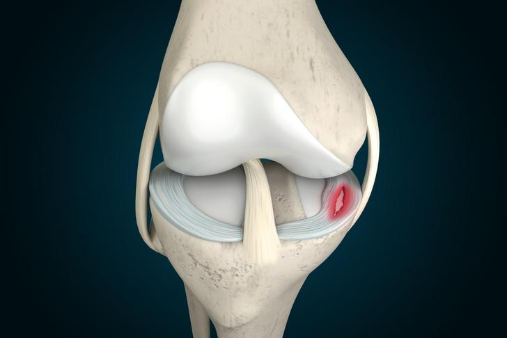meniscus tears-knee