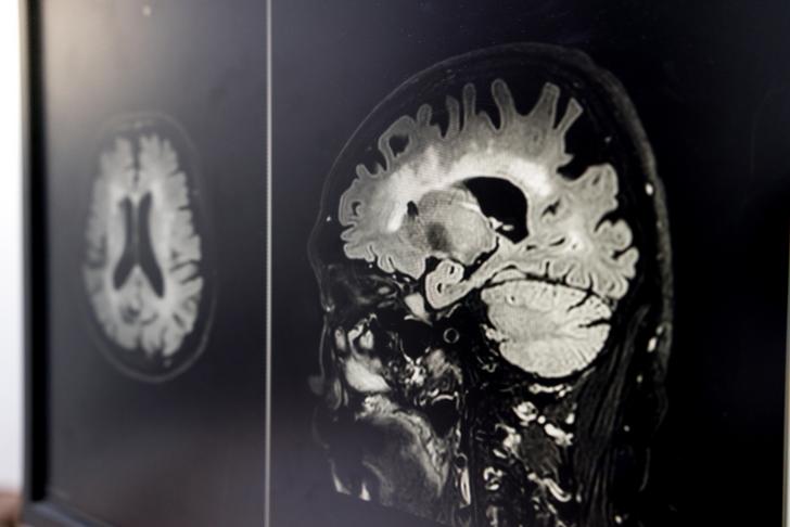 mixed dementia-vascular-dementia