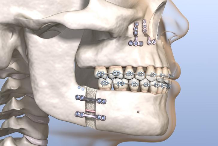 mma surgery