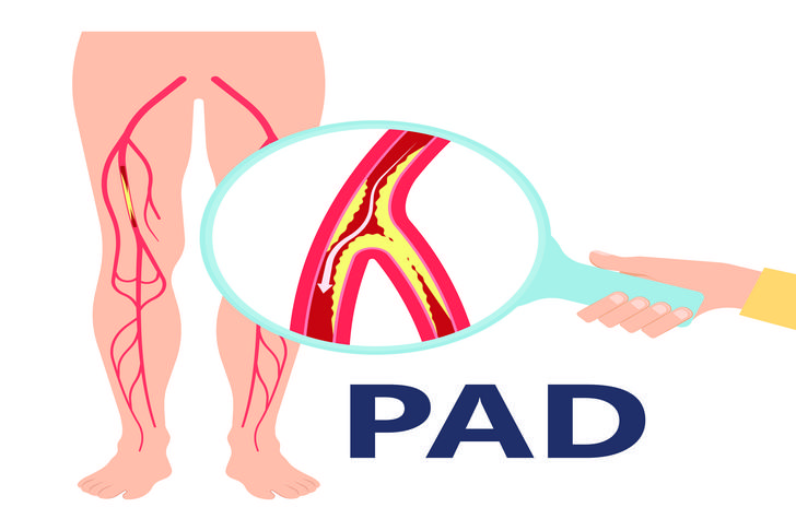 peripheral artery-disease-leg-cramps