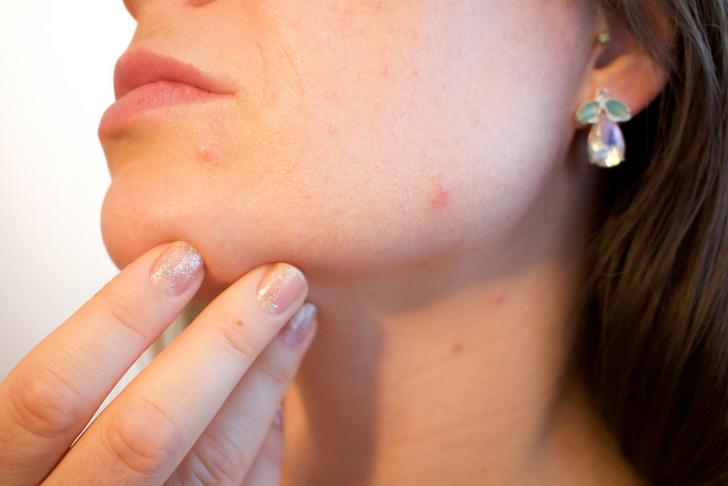 person holding the side of their face with red bumps