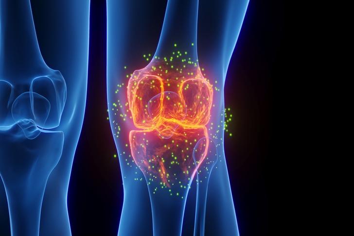 rheumatoid arthritis-knee
