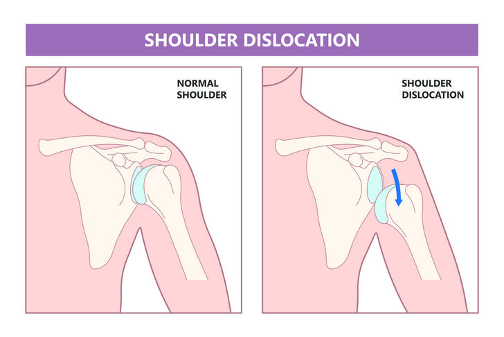 shoulder dislocation