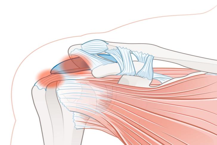 shoulder impingement