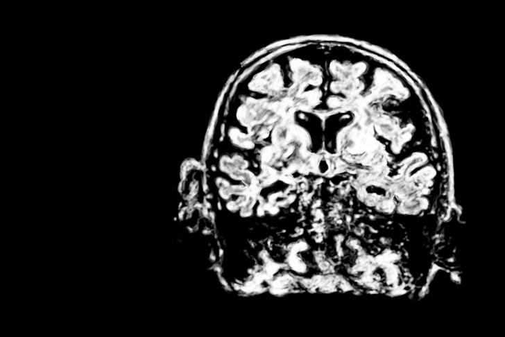 small vessel-disease-vascular-dementia