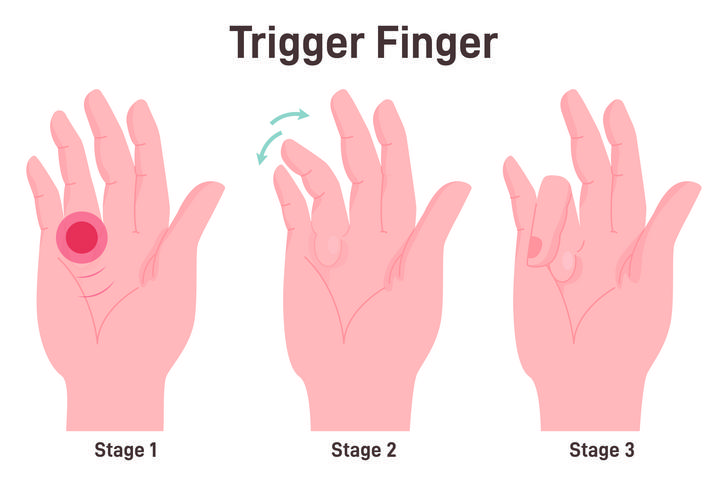 symptoms trigger-finger