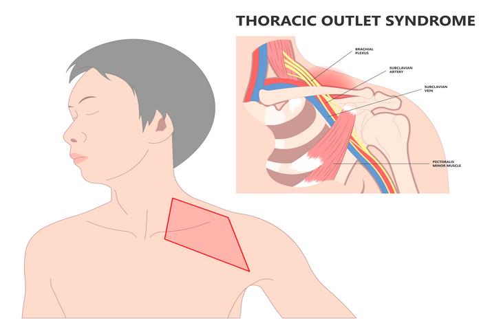 thoracic outlet-syndrome