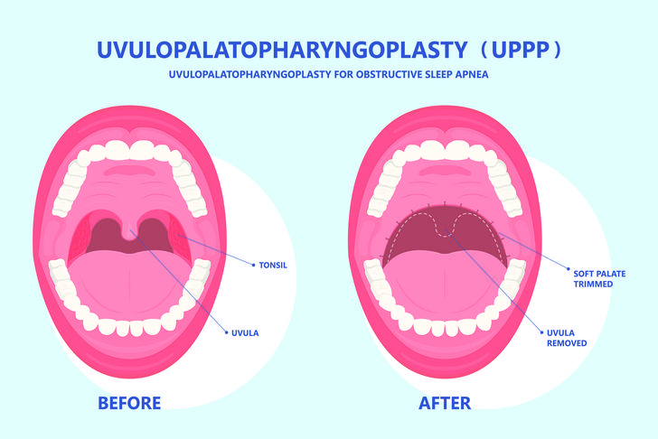 uppp surgery