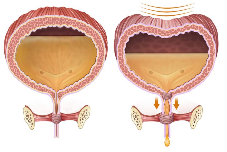 10-causes-of-urinary-tract-infections